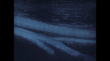 B-Flow -  Femoral Vessels