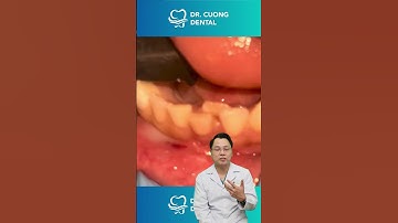 Răng cửa của trẻ mọc lệch | Bác sĩ Cường