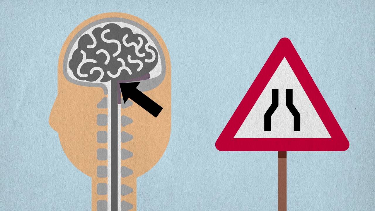 DSCM Syringomyelie und Chiari Malformation