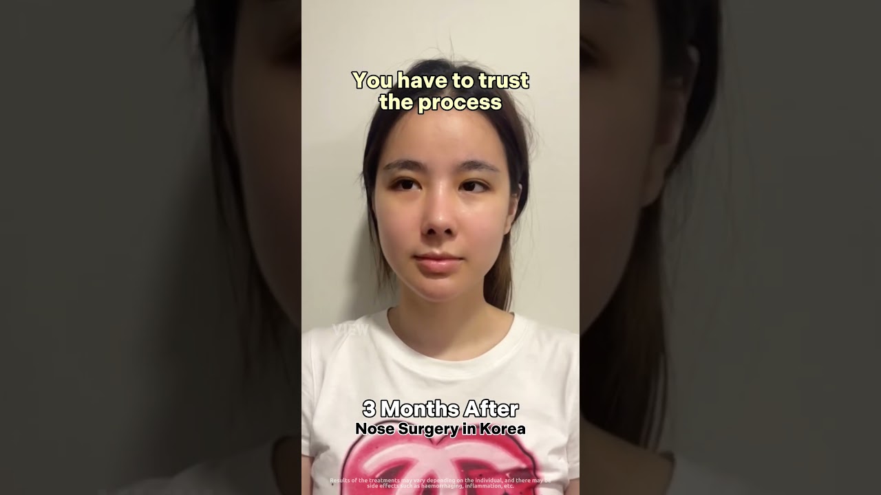 No one talks about this part on nose surgery… #korea #nosesurgery #plasticsurgery #vlog