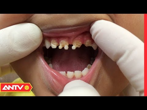 Video: Cách Chữa Răng Cho Trẻ Nhỏ