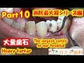 上尾の歯医者の歯周病治療。当院最大級の大量歯石取り(歯石除去)シリーズ　30代男性　パート10　,Mass tartar,टैटार, 韃靼,Tártaro,ขูดหินปูนKarang gigi