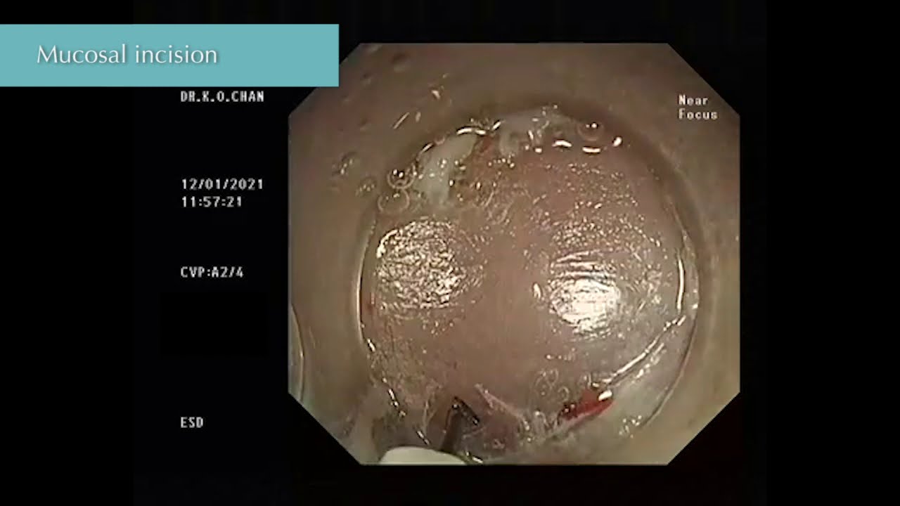 Submucosal tunnelling endoscopic resection (STER)