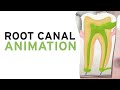 Root Canal Treatment (RCT) Step-by-Step Animation 🦷