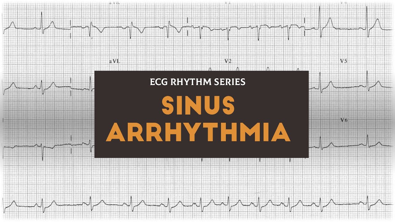 sinus arrhythmia magas vérnyomás