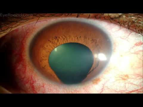 Vídeo: Salud Ocular Y Visual: Anatomía Ocular, 11 Afecciones Oculares Y Más