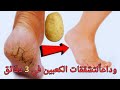 بحبة بطاطس وقولى وداعا لتشققات القدمين والكعبيين 