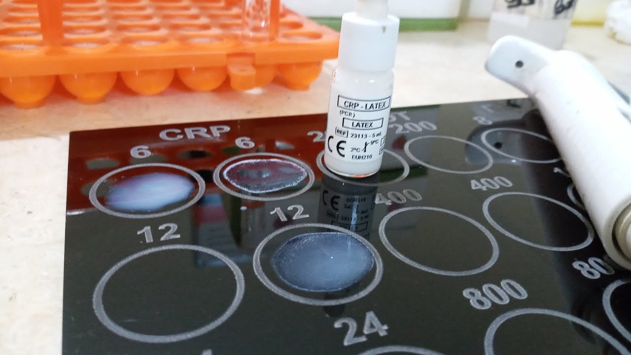 تحليل crp عملي والفرق بين العينه الايجابي والسالبي وعلاقة تحليل crp بفيرس كرونا - C-reactive protein