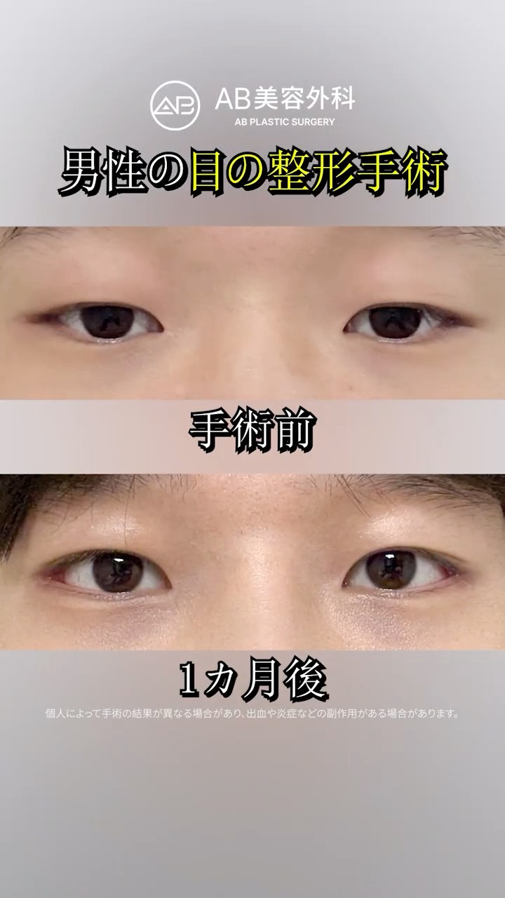 目整形で一気にイケメンな印象へ✨ #Shorts