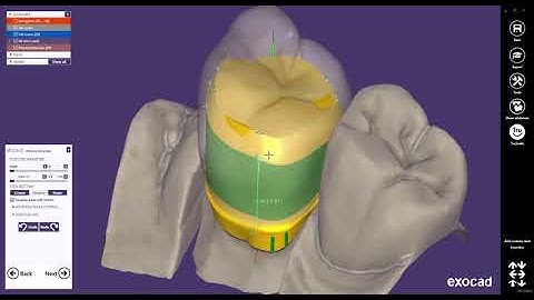 exocad Quick Guide  Advanced Telescopic Crown Design with Cutback