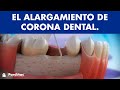 Alargamiento de corona dental ©