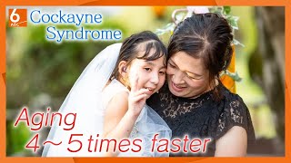 A 14 year old girl in the body of a 4 year old: Aging 4 to 5  times faster due to Cockayne Syndrome．