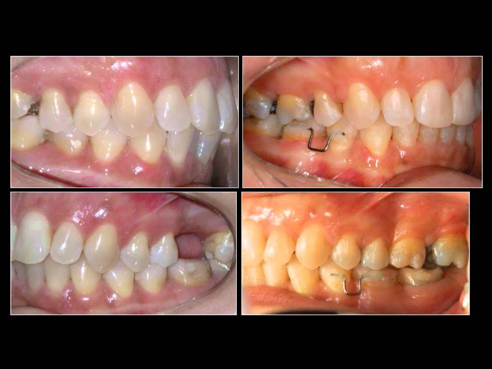 CONTENÇÕES EM ORTODONTIA