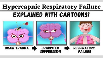 Hypercapnic (type 2) respiratory failure explained with cartoons!