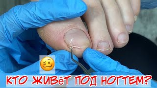 Как убрать подногтевую мозоль на ноге 😱 Почему болят ногти на ногах? 🥴