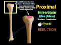 Tibial Plateau Fracture Fixation, Proximal Tibia - Everything You Need To Know - Dr. Nabil Ebraheim