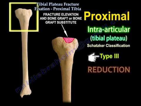 टिबिअल पठार फ्रैक्चर फिक्सेशन, समीपस्थ टिबिया - वह सब कुछ जो आपको जानना आवश्यक है - डॉ नबील इब्राहिम