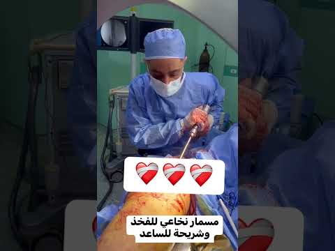 تركيب مسمار نخاعي لكسر بالفخذ و شريحة للساعد