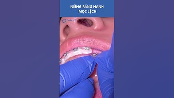 Niềng răng nanh mọc lệch I Nha Khoa Smile HT #smileht #nhakhoa #niengrang #buithientao #short