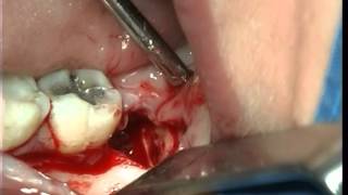 Horizontal impacted third molar removal