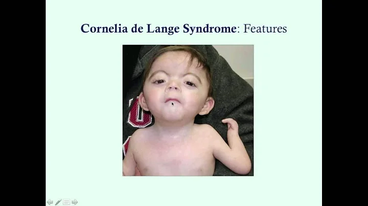 Cornelia de Lange Syndrome - CRASH! Medical Review...
