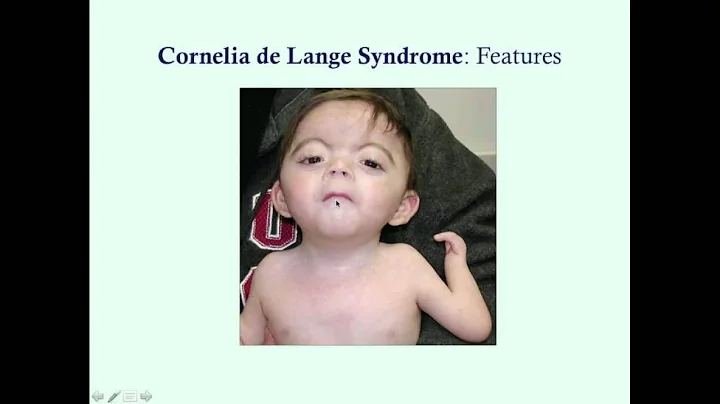 Cornelia de Lange Syndrome - CRASH! Medical Review...
