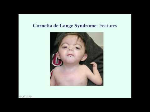 Cornelia de Lange Syndrome - کریش! میڈیکل ریویو سیریز