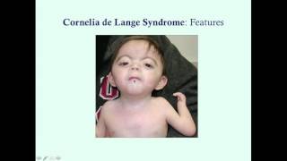 Cornelia de Lange Syndrome  CRASH! Medical Review Series