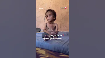 طفل أنهكت جسده حرب التجويع في قطاع غزة إلى جانب حرب القصف والرصاص والتشريد 