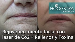 Rejuvenecimiento facial con láser de Co2 + Rellenos y Toxina (19126)