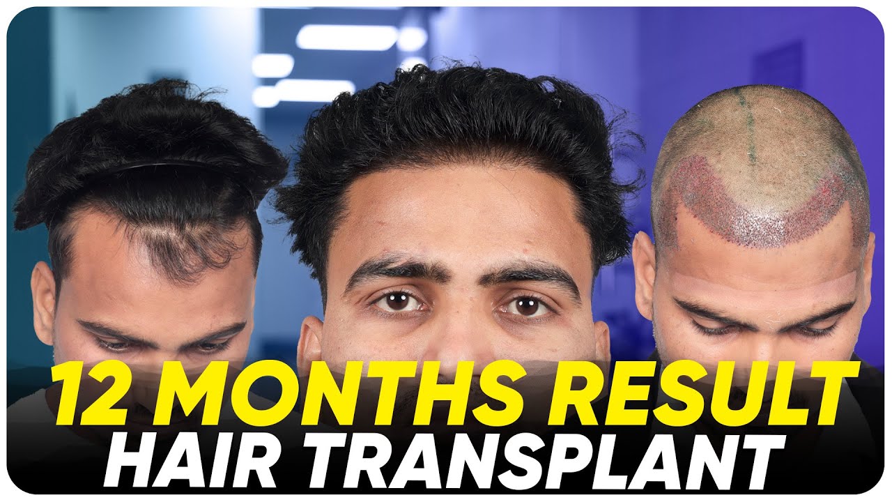 Hair Transplant in Abu Dhabi Best Results & Cost of Hair Transplant