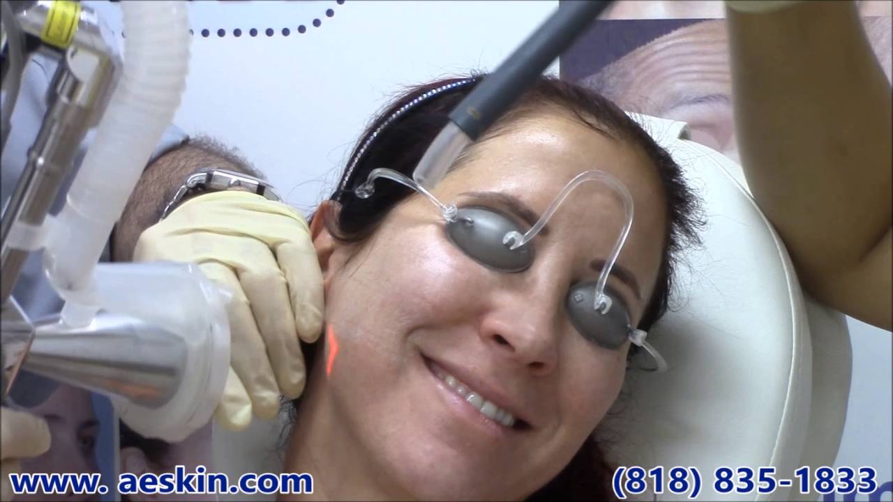 Micro Laser Peel Demonstration 2 - A E Skin - Encino, CA - 818-835-1833