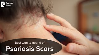 WILL PSORIASIS SCARS GO AWAY? Know the Main Causes & Symptoms - Dr. Chaithanya K S| Doctors' Circle