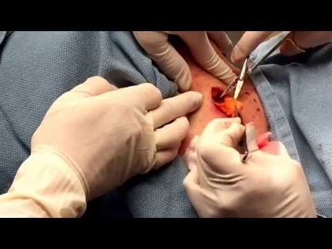 Excision Of A Lipoma On The Upper Back. For Medical Education- NSFE.