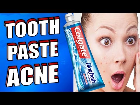 How To Apply Toothpaste on Pimples, Acne, Spots & Zits