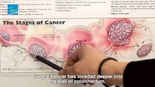 Different Stages of Colorectal Cancer
