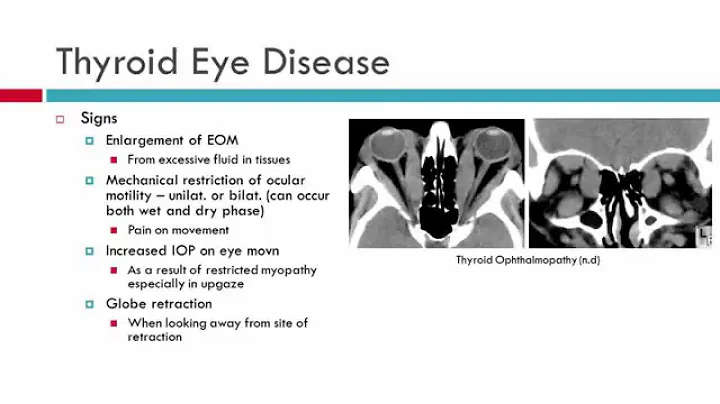 Thyroid Eye Disease Characteristics