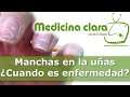 Manchas en las uñas, ¿por qué aparecen manchas  blancas en uñas?