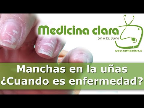 Vídeo: Manchas Blancas En Las Uñas: Causas Y Más