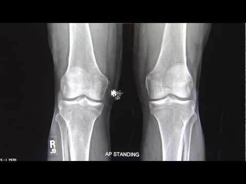 Video: Osteoartritis X-Ray Lutut