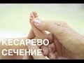 Роды через кесарево сечение || ОВП