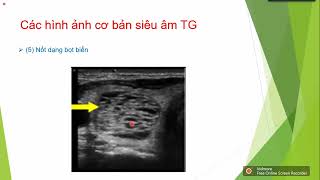 Siêu âm tuyến giáp: Cập nhật phân độ TI-RADS và chỉ định chọc hút tế bào tuyến giáp (FNA)