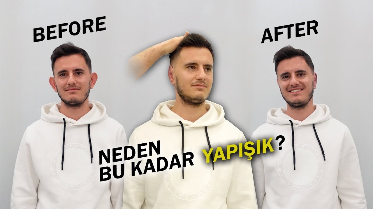 Kulaklarım Neden Bu Kadar Yapışık Oldu? Kepçe Kulak Estetiği Oldum! @VeyselBerk0