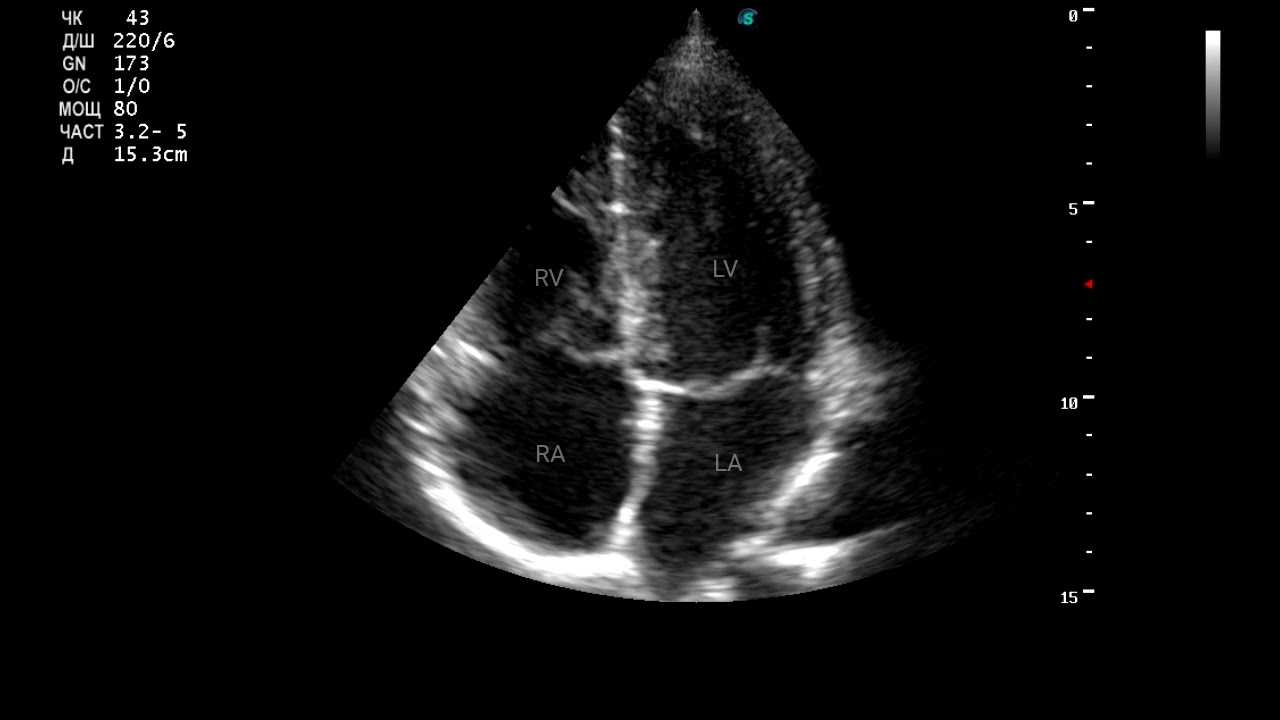 Эхо кардиография. Трансторакальная ЭХОКГ методика. Эхокардиография Эхо кг УЗИ сердца. УЗИ сердца снимки.
