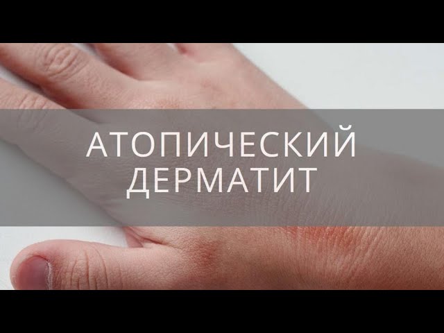 #Атопический дерматит.Уход за #кожей, мази,правила жизни с сыпью у детей.