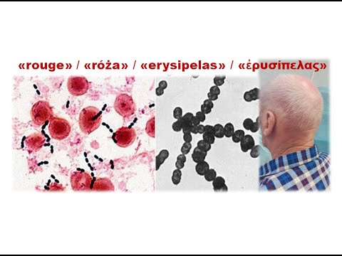 Βίντεο: Τι είναι η ερυσίπελα του προσώπου;