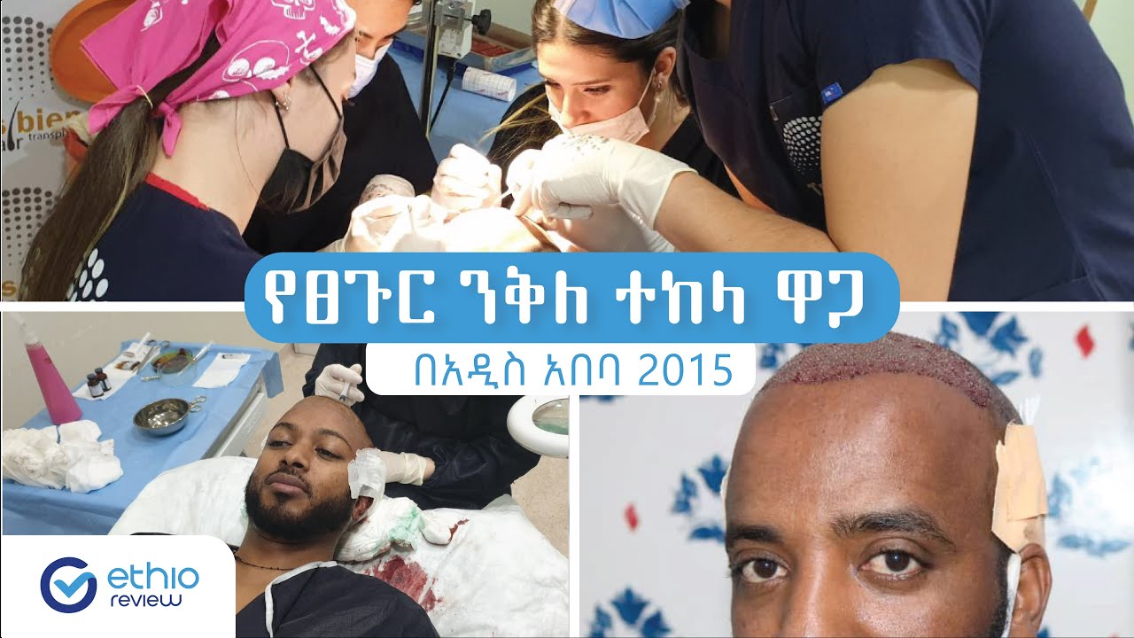 የፀጉር ንቅለ ተከላ ዋጋ በአዲስ አበባ 2015 / Hair Transplant Price in Addis Ababa  Ethiopia | Ethio Review