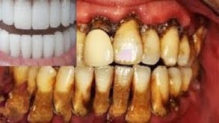 (مذهله) اقوى طريقه لازالة الجير والرواسب البكتريا ازالة جير الاسنان فى دقيقتين وداعا اطباء الاسنان!!