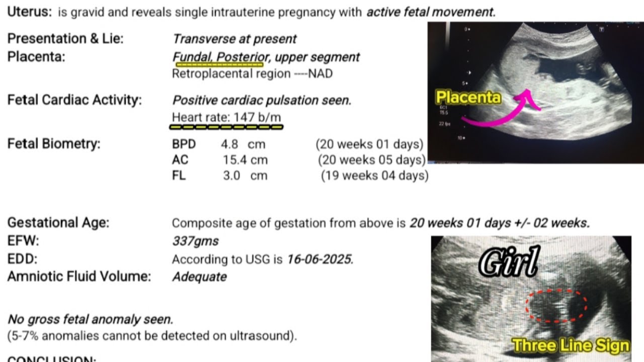 Pregmency Scan Report 20 Weeks 1 Day Pregnancy Scan Report | Fundoposterior Placenta (Boy ...