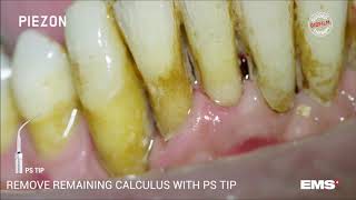 Dentální hygiena - EMS ultrazvuk